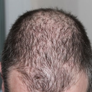 Krestina Pro - Trattamento professionale anticaduta dei capelli